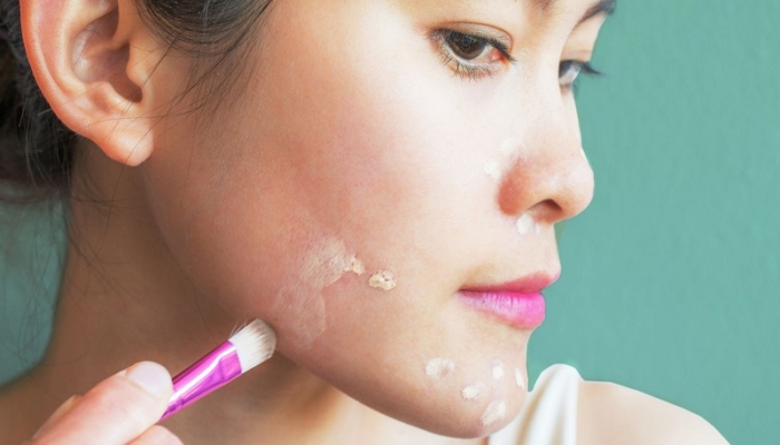 catat,-ini-4-tips-menggunakan-concealer-untuk-tutupi-jerawat