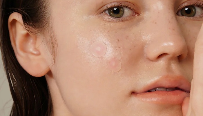 hilangkan-jerawat,-ini-4-tipe-acne-patch-yang-bisa-kamu-coba