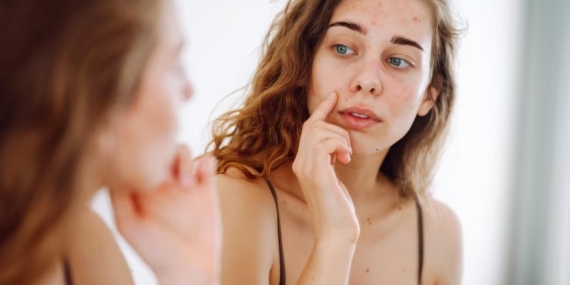 Kenali Manfaat Kandungan Salicylic Acid dalam Skincare