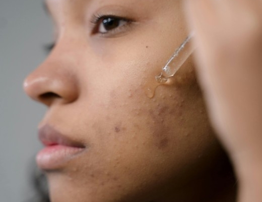 6-rekomendasi-skincare-untuk-jerawat-papula-yang-aman