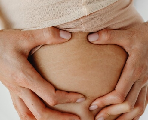 6-tips-merawat-kulit-stretch-mark-di-paha