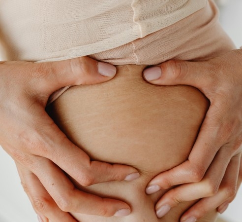 6-tips-merawat-kulit-stretch-mark-di-paha