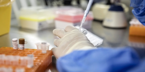 Meningkatkan Sel Kekebalan Tubuh Dapat Membantu Mengendalikan HIV dalam Jangka Panjang
