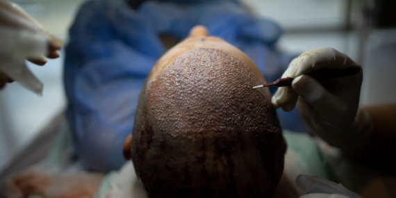 Bagaimana Turki Meretas Industri Transplantasi Rambut
