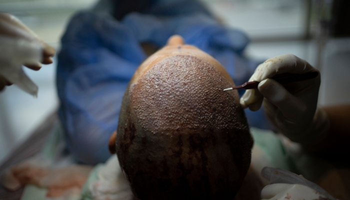 bagaimana-turki-meretas-industri-transplantasi-rambut