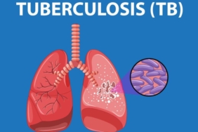 dinkes-kota-tasikmalaya-temukan-1.239-warga-positif-tuberkulosis,-18-di-antaranya-resisten-obat