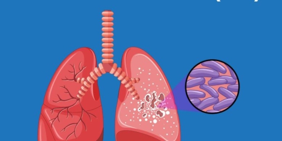 Dinkes Kota Tasikmalaya Temukan 1.239 Warga Positif Tuberkulosis, 18 di Antaranya Resisten Obat