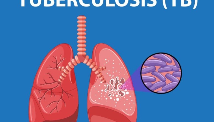 dinkes-kota-tasikmalaya-temukan-1.239-warga-positif-tuberkulosis,-18-di-antaranya-resisten-obat