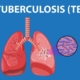 dinkes-kota-tasikmalaya-temukan-1.239-warga-positif-tuberkulosis,-18-di-antaranya-resisten-obat