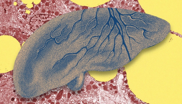 there’s-a-fatty-liver-epidemic.-ai-could-help-get-ahead-of-it