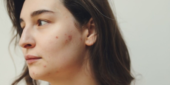 Penting! Ini 5 Perbedaan Fungal Acne dan Bruntusan